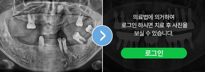 부천 사과나무치과병원 임플란트 치료전후 사진 증례