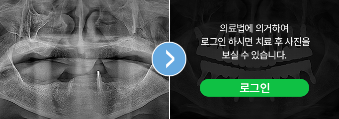 부천 사과나무치과병원 뼈이식 임플란트 치료전후 사진 증례