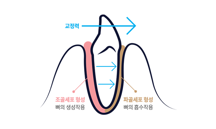 중년 교정의 중요성