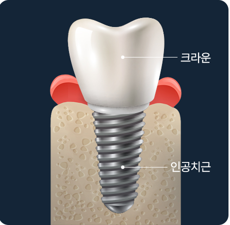 임플란트의 구조