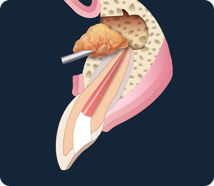 치근단 절제술
